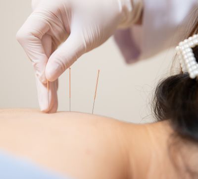 Acupuncture for Stress Relief: A Holistic Approach to Well-being