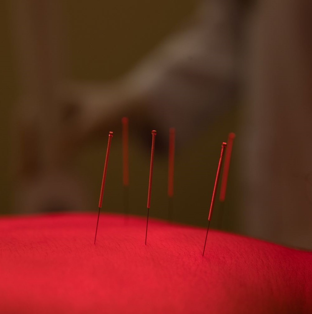 Acupuncture for Hip Pain: Effective Relief and Treatment