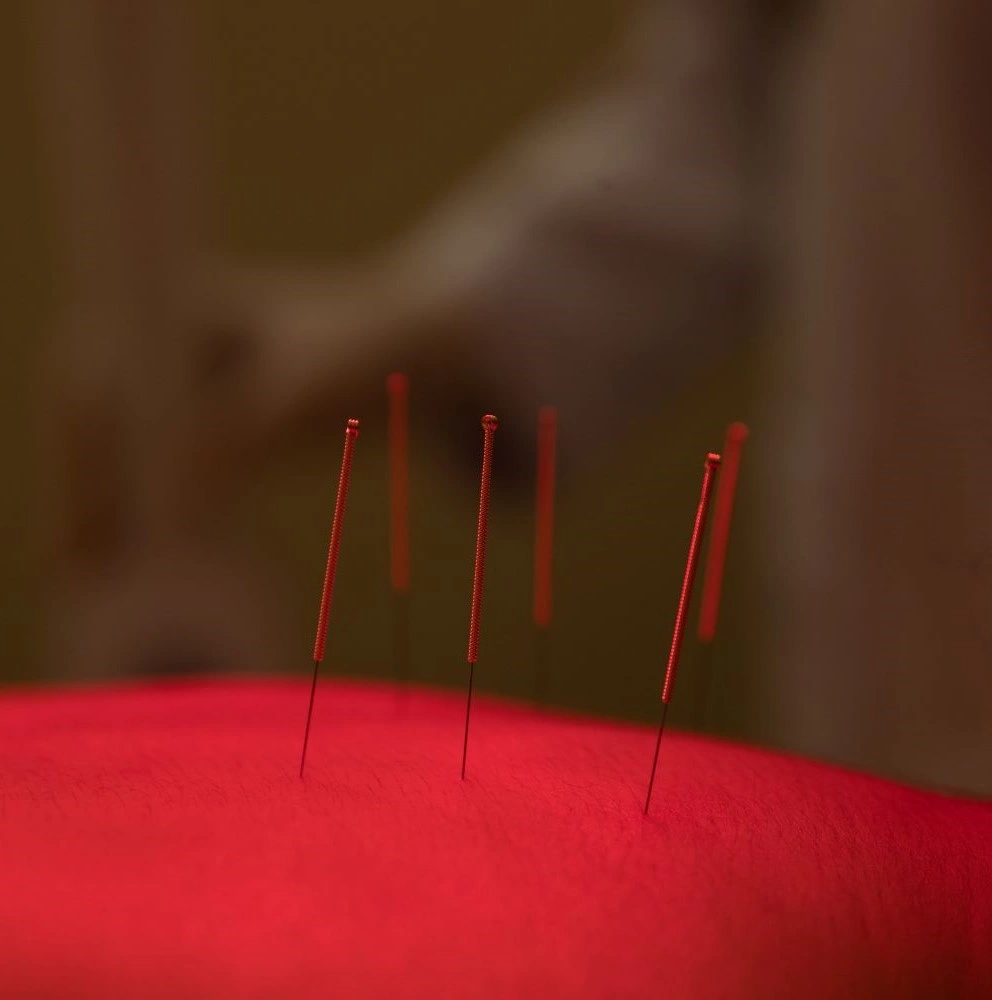 Acupuncture for Hip Pain: Effective Relief and Treatment