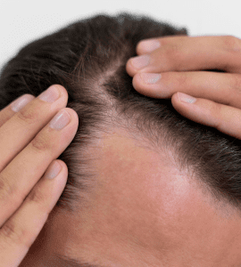 Advanced Hairfall Screening - Male